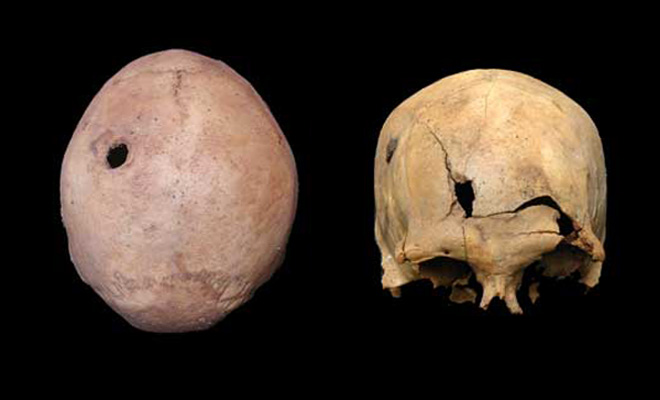 Inca skulls