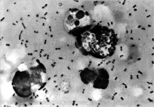 Yersinia pestis in the lymph of a plague patient