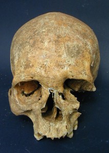 Skull of warrior with Hansen's disease, characteristic wasting of bone visible in nose, upper jaw area