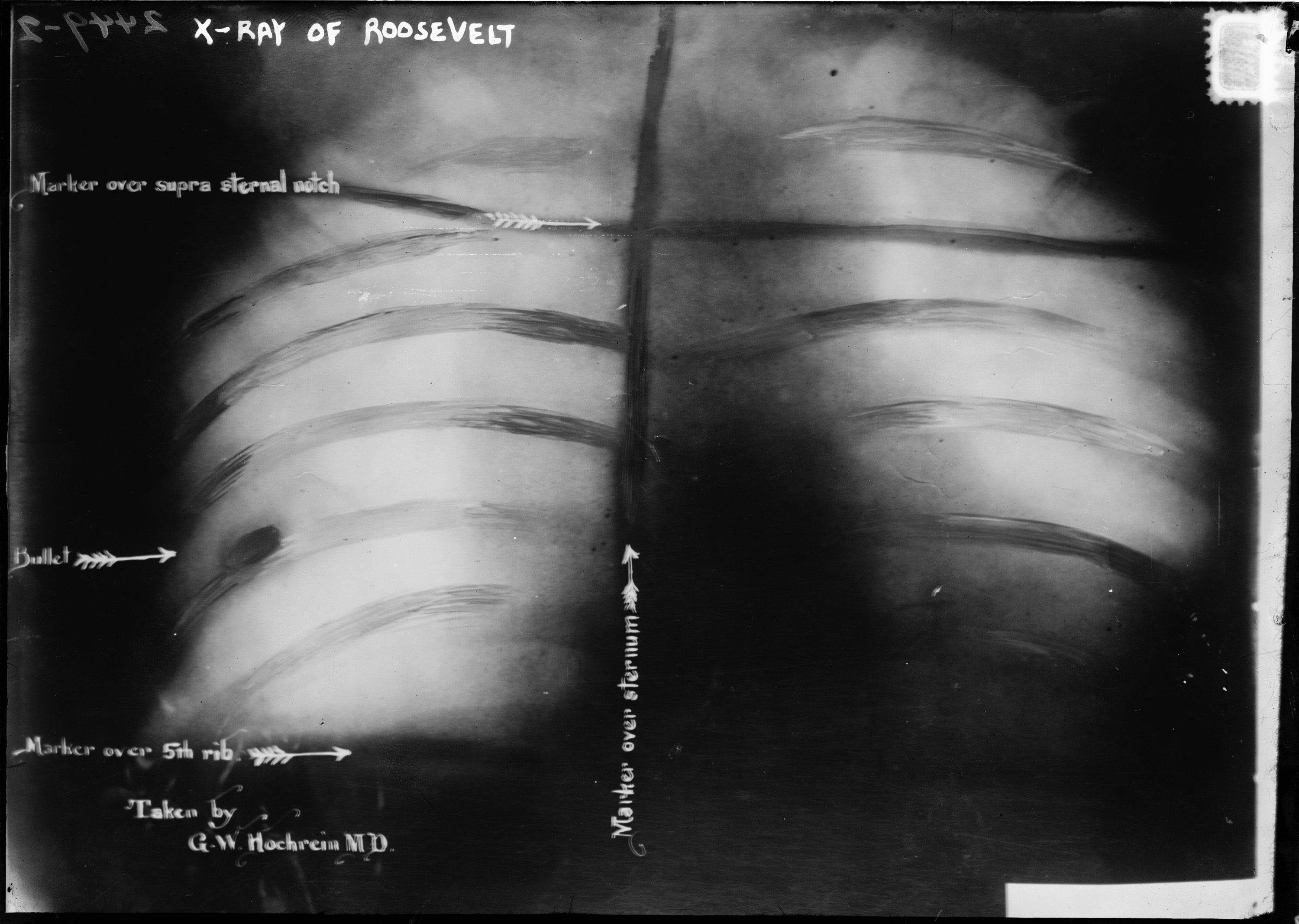 Roosevelt-X-ray.jpg