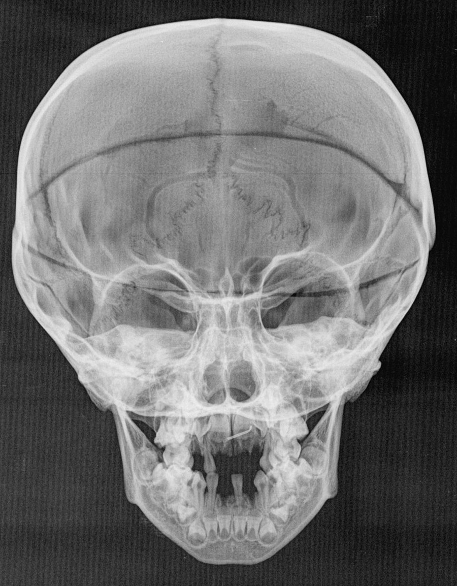 Детский череп рентген. Рентгенография черепа ребенка. Рентгенограмма черепа новорожденного. Рентген черепа новорожденного ребенка.